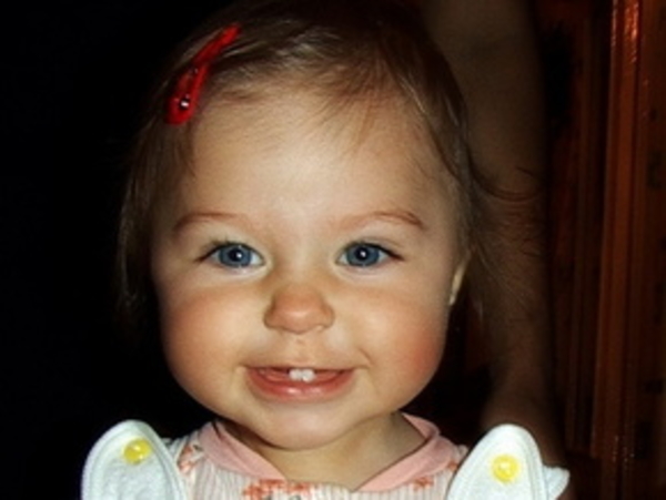 Детский кариес