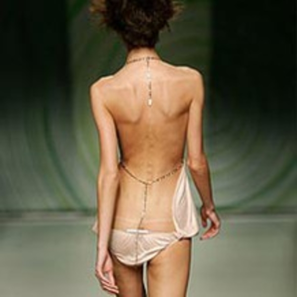 Анорексия, или мода на болезнь