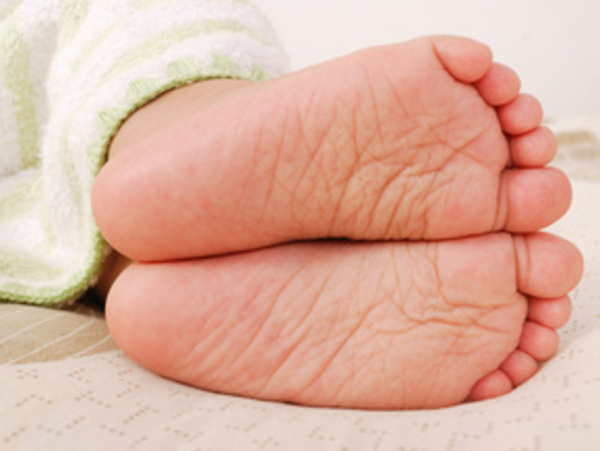 Косолапость –  порок развития стопы