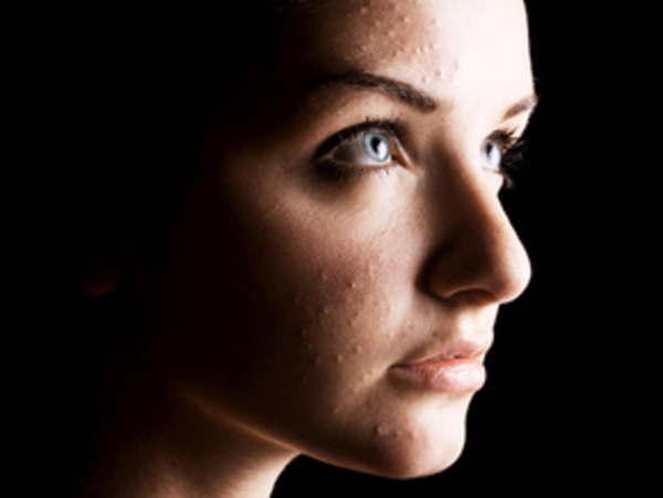 Как избавиться  от прыщей и угрей с помощью чеснока