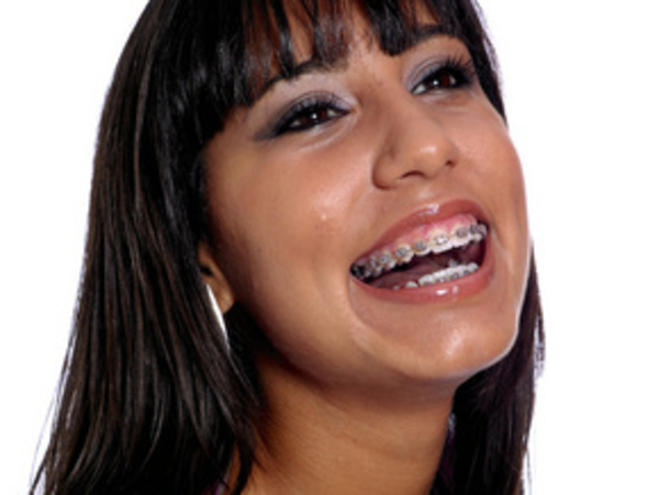 Керамические брекеты: красота зубов не требует жертв