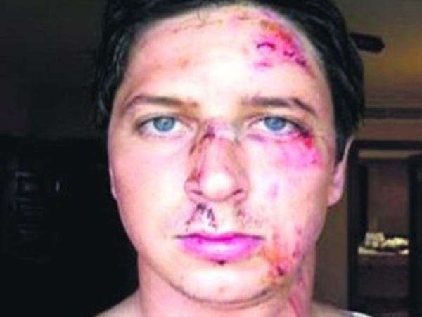 Педана серьезно покалечили