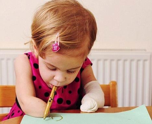 Тяжелая болезнь оставила ребенка без конечностей