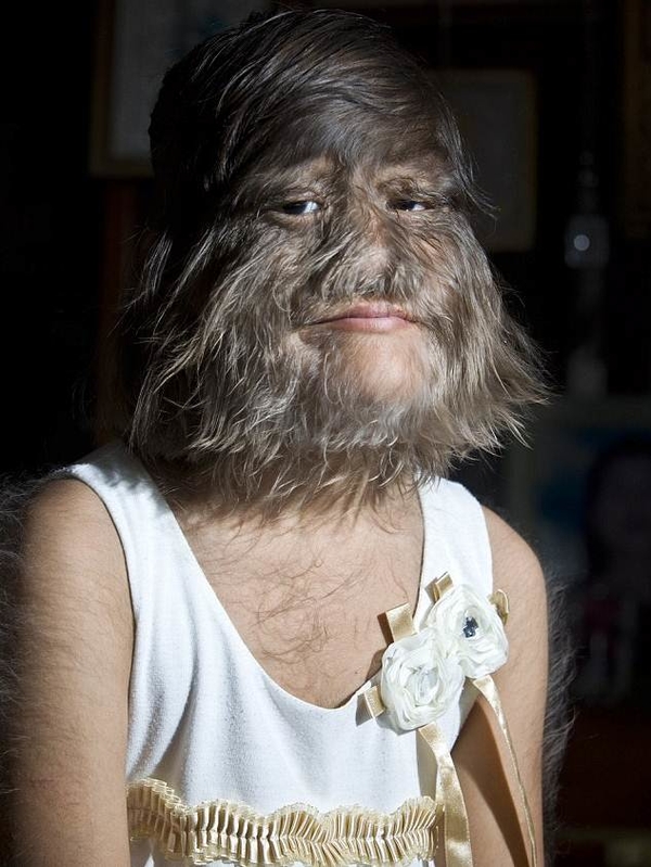 В Таиланде живет самая волосатая девочка в мире