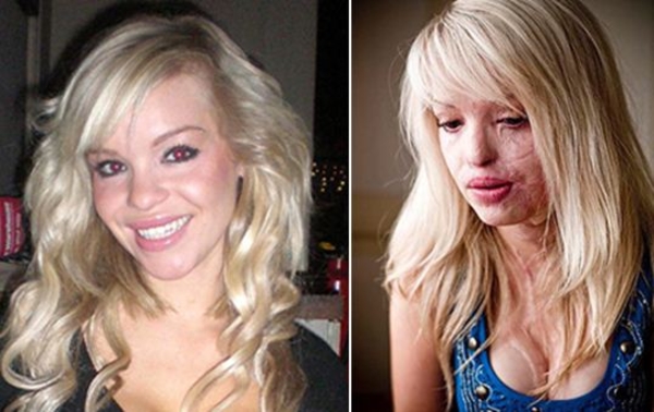 Обожженная кислотой фотомодель написала книгу