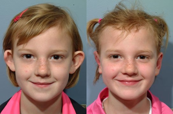 7-летней школьнице сделали пластическую операцию