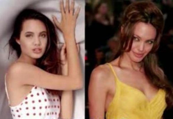 Звезды: До и после пластической операции