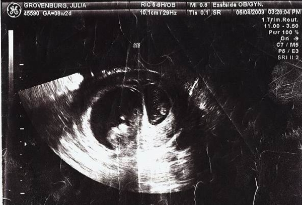 Женщина забеременела, будучи уже беременной