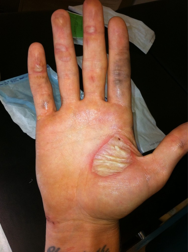 Алексей Воробьев получил на съемках страшный ожог