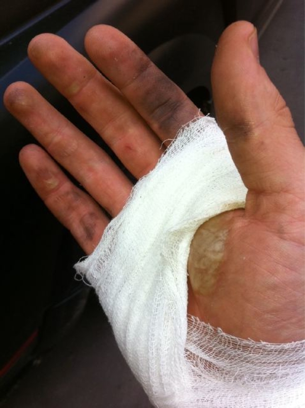 Алексей Воробьев получил на съемках страшный ожог