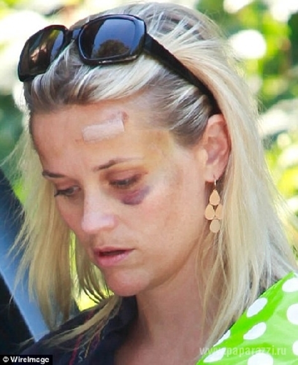 Риз Уизерспун вышла в свет с огромным синяком