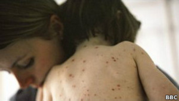 Ультрафиолет препятствует распространению ветрянки