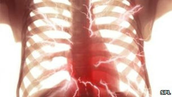 Число сердечных приступов в Британии уменьшилось вдвое