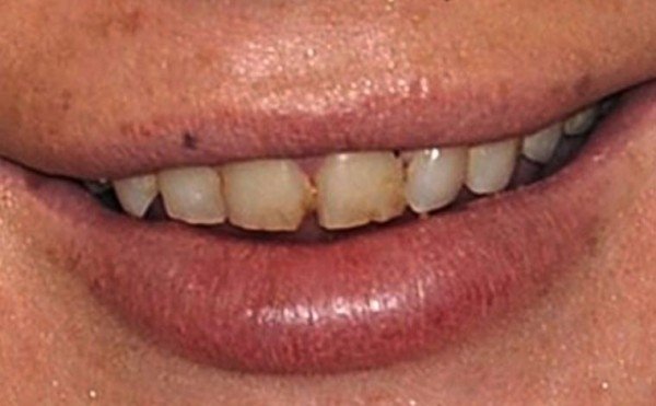 Линдси Лохан "скурила" свои пальцы