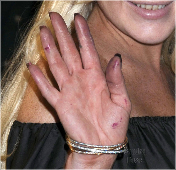 Линдси Лохан "скурила" свои пальцы