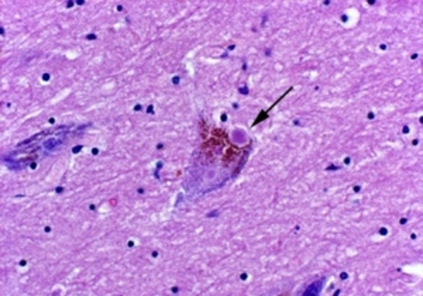 Начались испытания первой вакцины от болезни Паркинсона