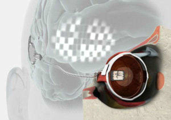 Австралийские ученые испытали бионический глаз, вживленный человеку