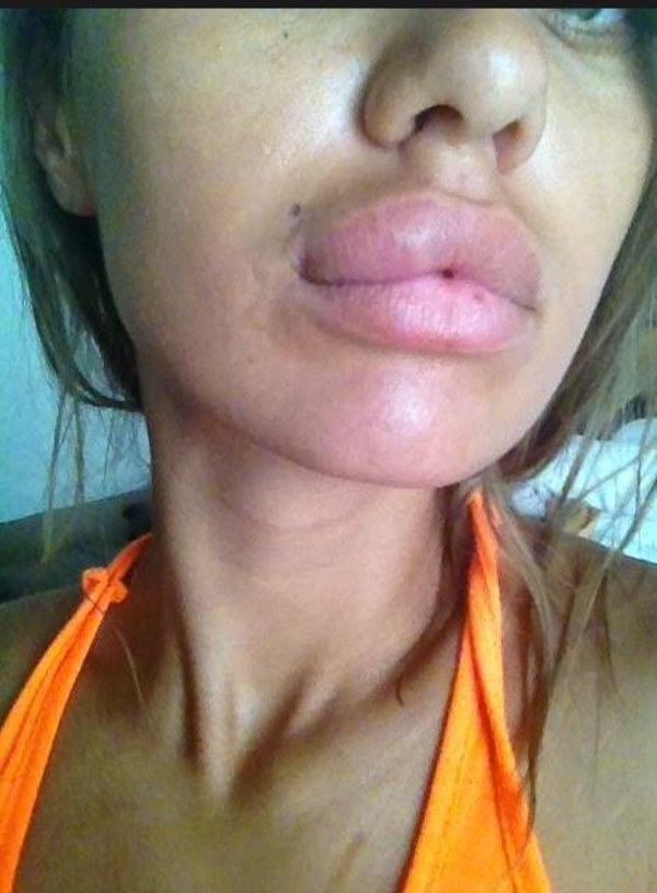 Викторию Боню укусило ядовитое насекомое