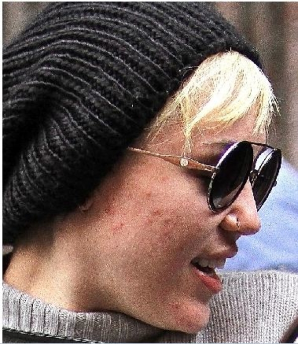 У Майли Сайрус проблемы с кожей