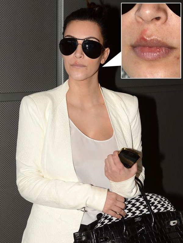 Макияж не помог Ким Кардашян спрятать герпес