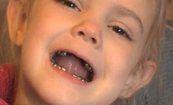 В США дантист установил 4-летнему ребенку металлические коронки на все зубы