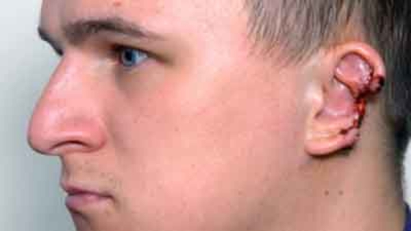 Звезде зарубежных глянцев в ходе драки откусили половину уха