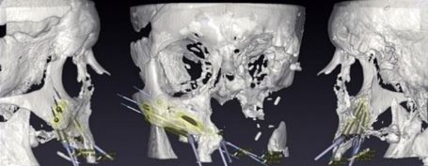 Мужчине, потерявшему часть лица, напечатали ее на принтере