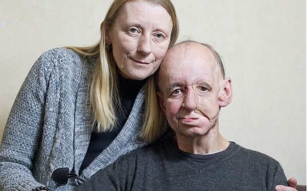 Мужчине, потерявшему часть лица, напечатали ее на принтере