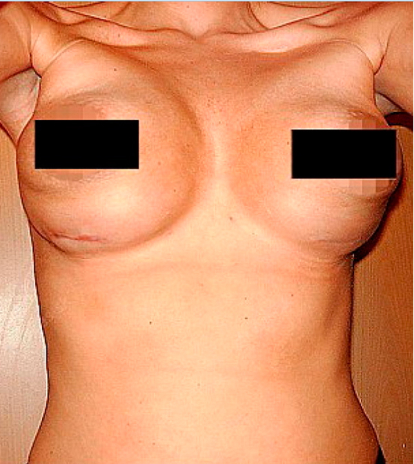 Пластическая операция изуродовала женщине грудь