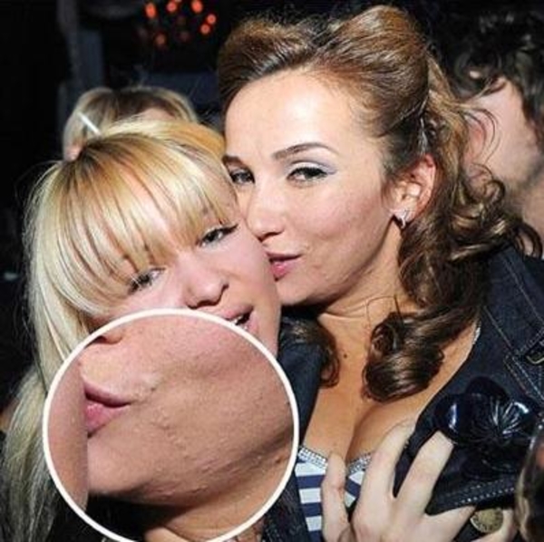 У Анфисы Чеховой проблемы с кожей?