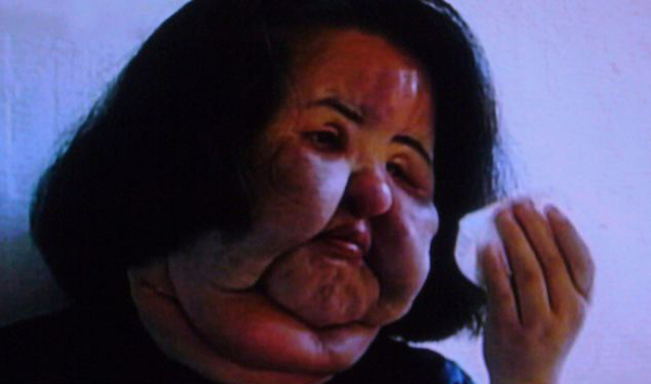 Бывшая модель изуродовала себя инъекциями растительного масла