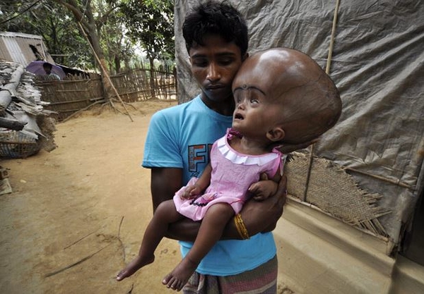 Девочке, которая поразила врачей жутким черепом, сделали операцию