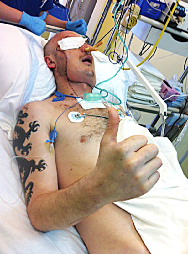 Хирурги провели первую в мире экстренную пересадку лица