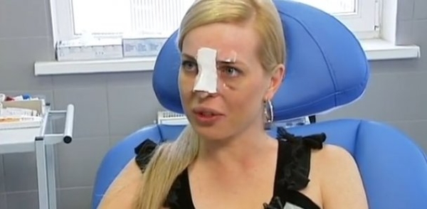 Таня Стребкова из Холостяка шокировала снимками после пластики носа