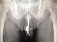 Вилка, застрявшая в половом члене – результат сексуальной игры 70-летнего мужчины