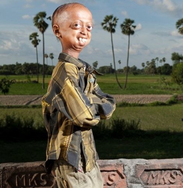 В теле старика: 14-летний мальчик из Индии выглядит на 110 лет