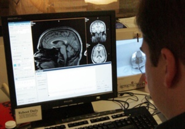 Ученые нашли гены, повышающие риск развития рассеянного склероза