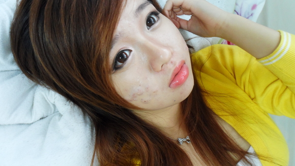 Борьба за идеальную кожу: Девушка показала, как маскирует ужасные акне