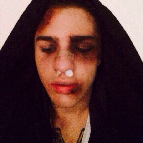 Рома Желудь в реанимации: Одна остановка сердца, состояние нестабильное