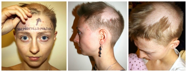 Из-за серьезного расстройства девушка вырвала у себя почти все волосы