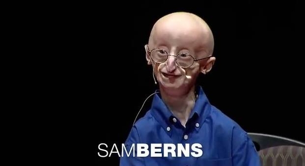 В США скончался 17-летний парень, живущий в теле старика