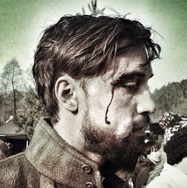 Дима Билан опубликовал в Сети фото окровавленного лица