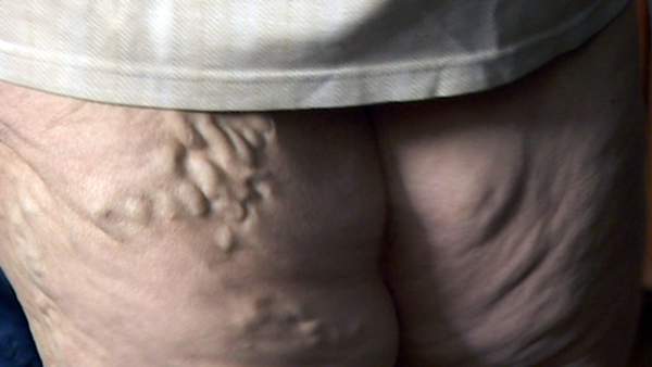 Я соромлюсь свого тіла: Храп, варикоз и гнойный гайморит