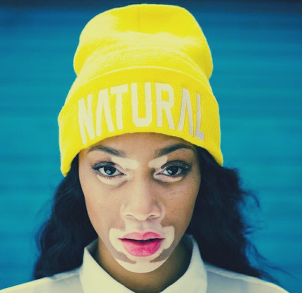 Любовь к жизни: Девушка с болезнью кожи стала моделью