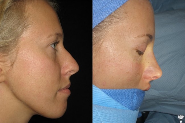 Ксения Собчак сделала пластику носа: Фото до и после