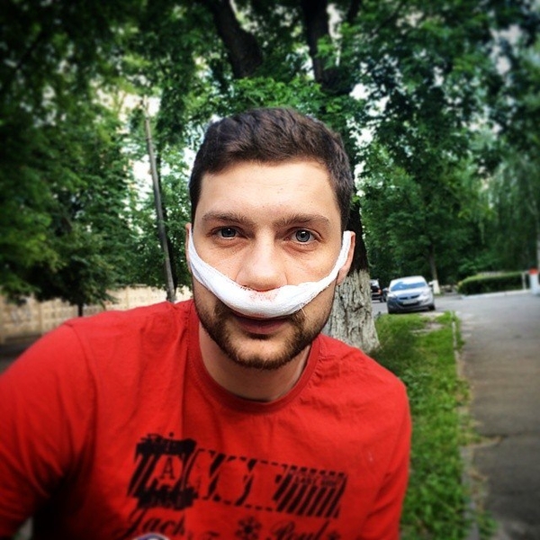 Финалист шоу Х-фактор Олег Кензов сделал пластику носа