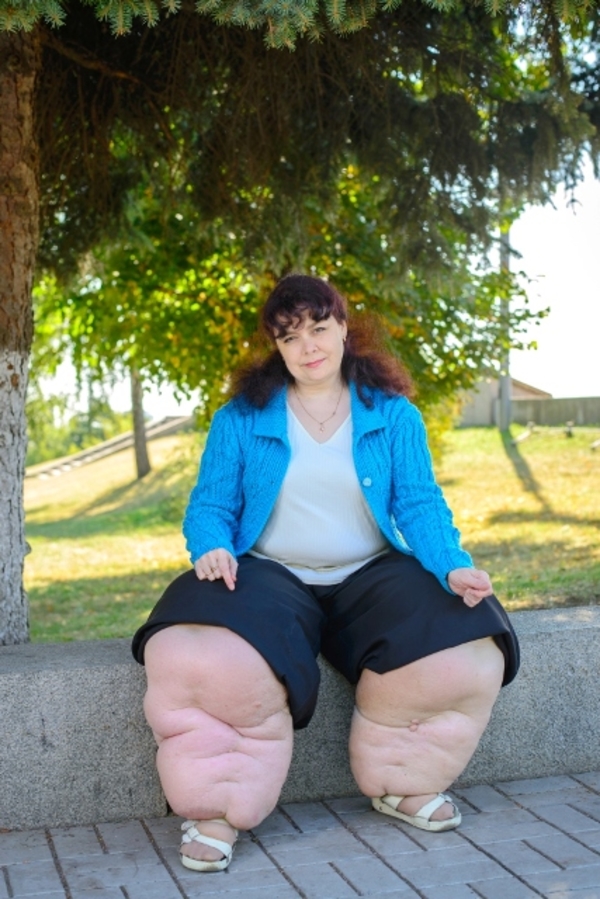 Я соромлюсь свого тіла: Татьяна Лапченко рассказала о своем лечении