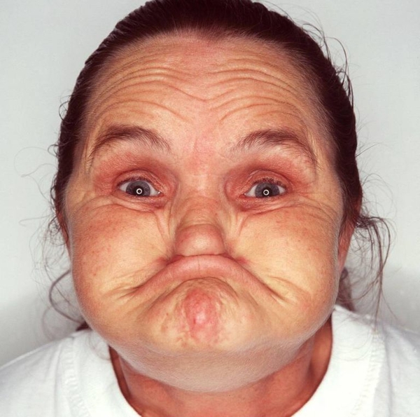 На 67-м году жизни умерла "самая уродливая женщина в мире"