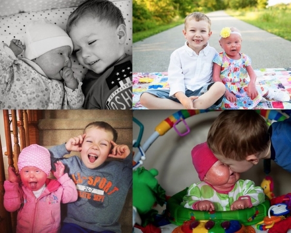 Вдохновляет: История одной маленькой девочки с синдромом ихтиоза