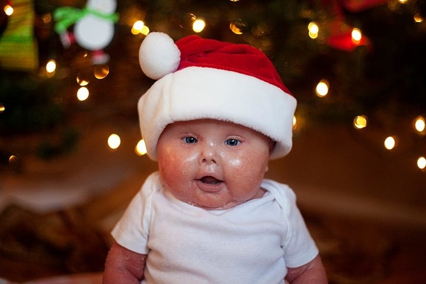 Вдохновляет: История одной маленькой девочки с синдромом ихтиоза